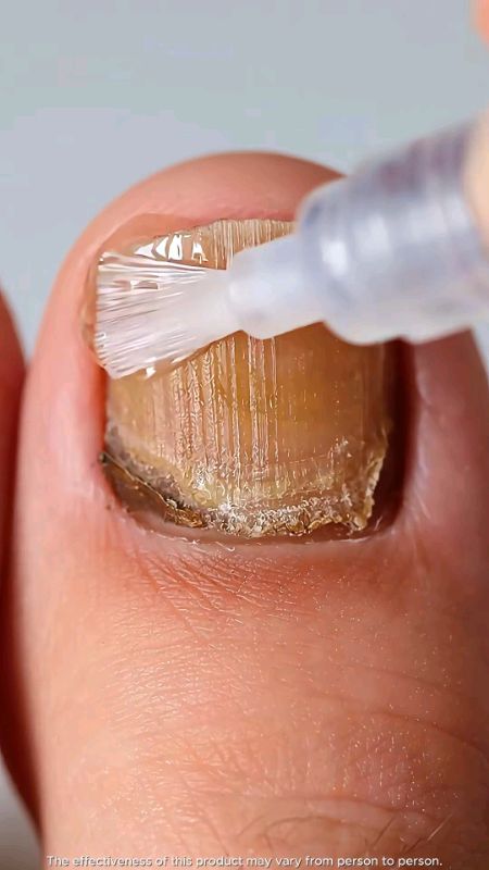#Trading OEDO Nail Repair Essence Serum Fungal Nail Treatment Remove Onychomycosis Toe Hand Foot Skin Care 30ml#fly arat na guyz❤️