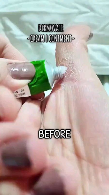#skin #skinproblem #dermovate #clobetasol #psoriasis #kati #eczema #dermatitis