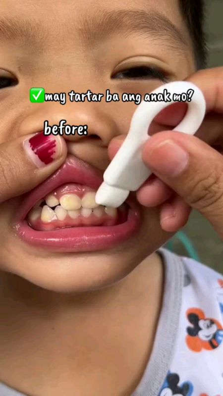 [3PCS] Nano Teeth Whitening Eraser - Instant Tartar & Plaque Remover, Safe for Kids & Adults #teeth #whitening #HugotSaShopee #MasMuraSaShopee